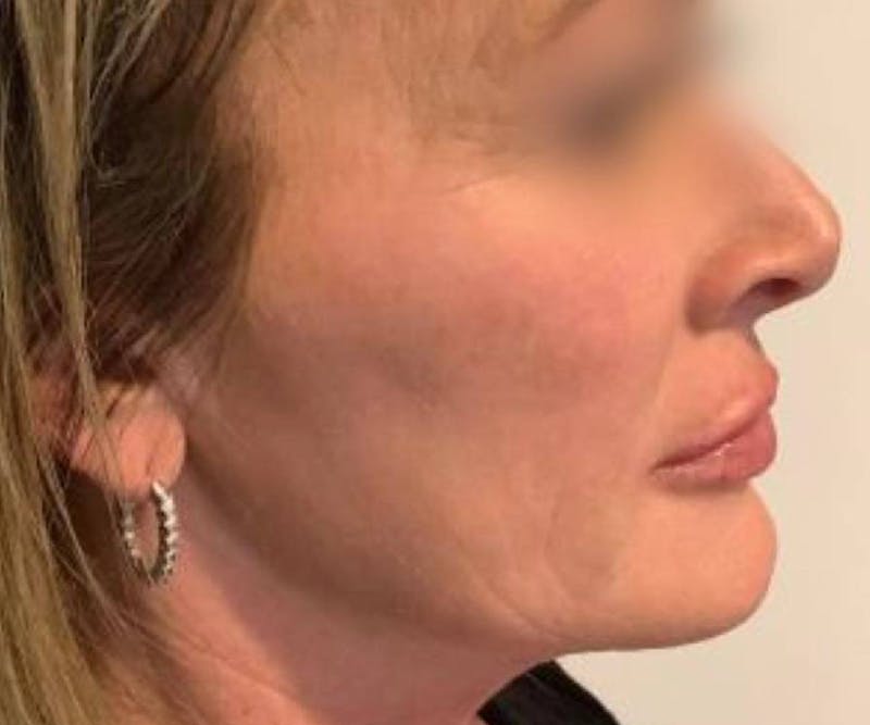 BBL | MOXI Before & After Gallery - Patient 425129 - Image 2 - Scott Chapin, MD