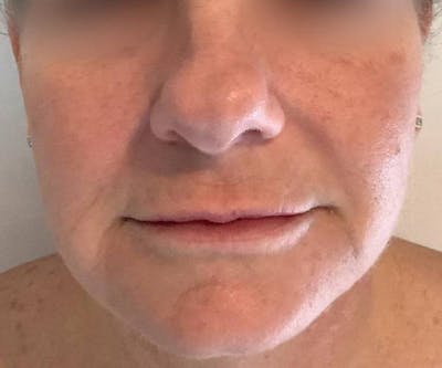 BBL | MOXI Before & After Gallery - Patient 146743 - Image 1 - Scott Chapin, MD