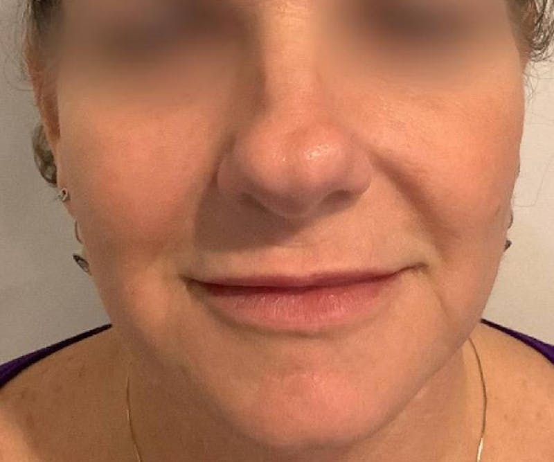 BBL | MOXI Before & After Gallery - Patient 146743 - Image 2 - Scott Chapin, MD