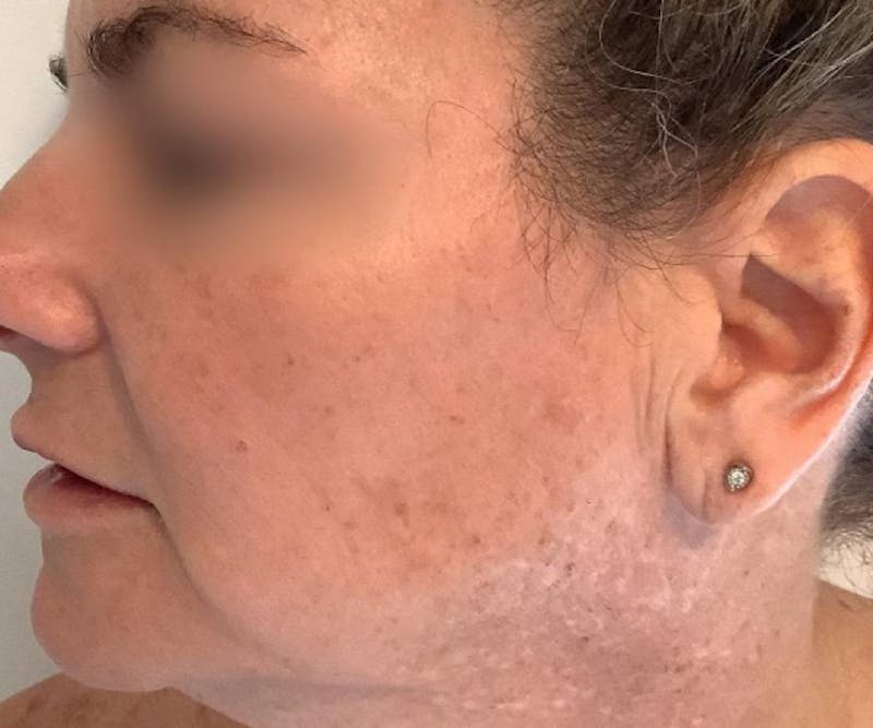 BBL | MOXI Before & After Gallery - Patient 146743 - Image 5 - Scott Chapin, MD