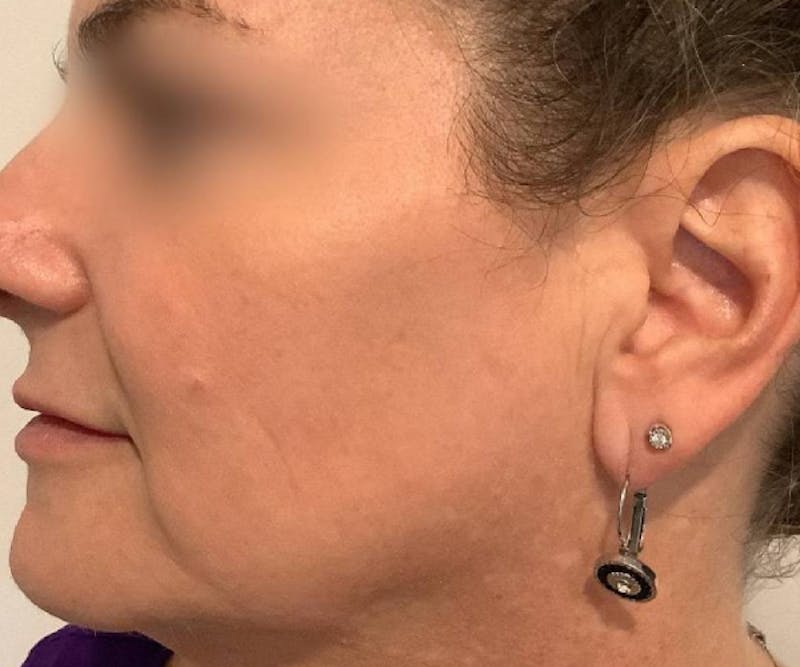 BBL | MOXI Before & After Gallery - Patient 146743 - Image 6 - Scott Chapin, MD