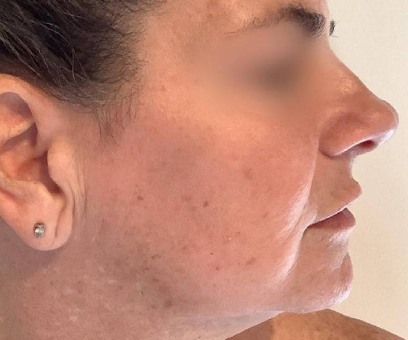 BBL | MOXI Before & After Gallery - Patient 146743 - Image 7 - Scott Chapin, MD