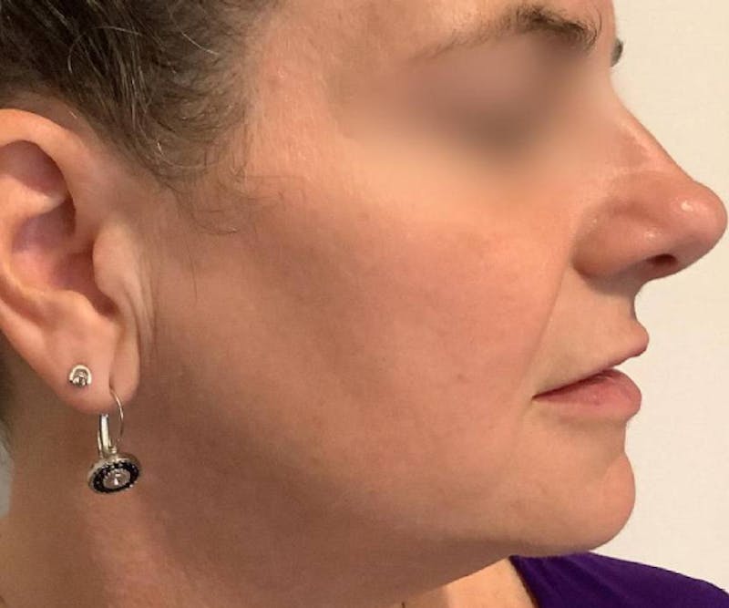 BBL | MOXI Before & After Gallery - Patient 146743 - Image 8 - Scott Chapin, MD