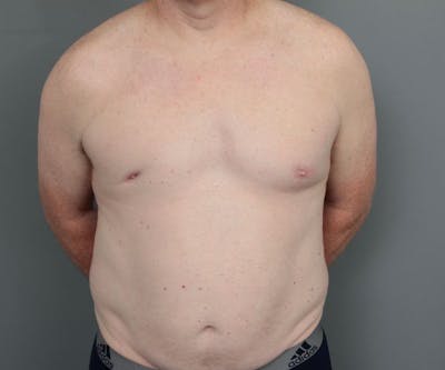 Male Breast Reduction Before & After Gallery - Patient 226347 - Image 1 - Scott Chapin, MD