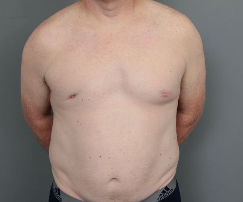 Male Breast Reduction Before & After Gallery - Patient 226347 - Image 1 - Scott Chapin, MD