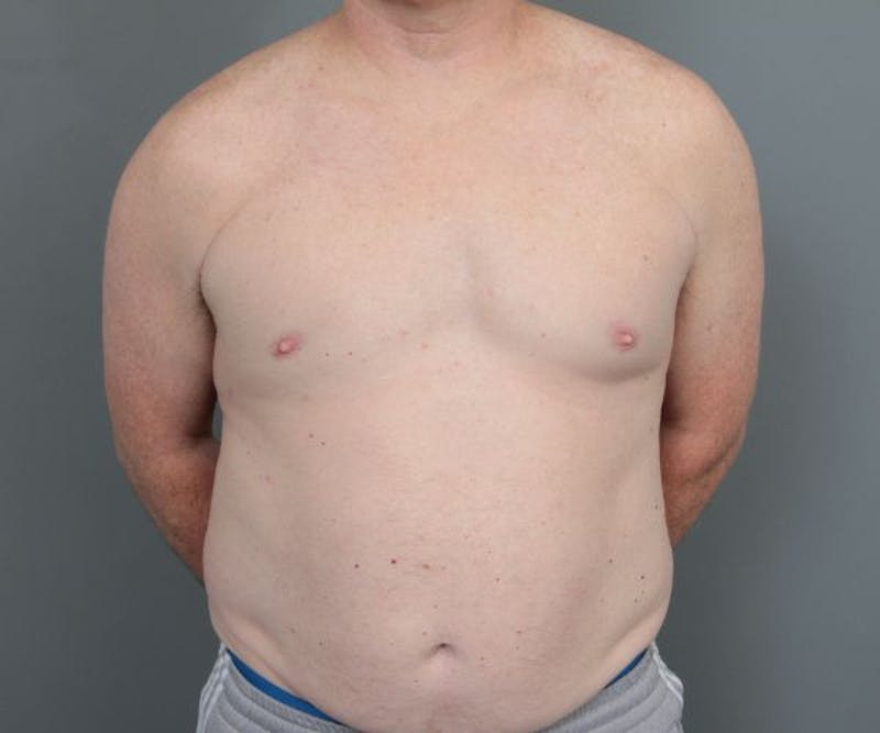 Male Breast Reduction Before & After Gallery - Patient 226347 - Image 2 - Scott Chapin, MD