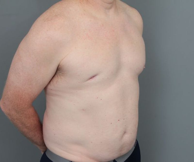 Male Breast Reduction Before & After Gallery - Patient 226347 - Image 3 - Scott Chapin, MD