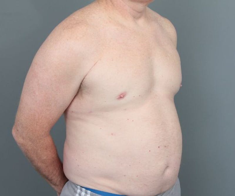 Male Breast Reduction Before & After Gallery - Patient 226347 - Image 4 - Scott Chapin, MD