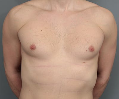Male Breast Reduction Before & After Gallery - Patient 342061 - Image 1 - Scott Chapin, MD