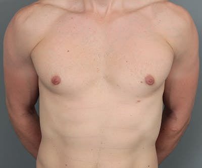 Male Breast Reduction Before & After Gallery - Patient 342061 - Image 2 - Scott Chapin, MD