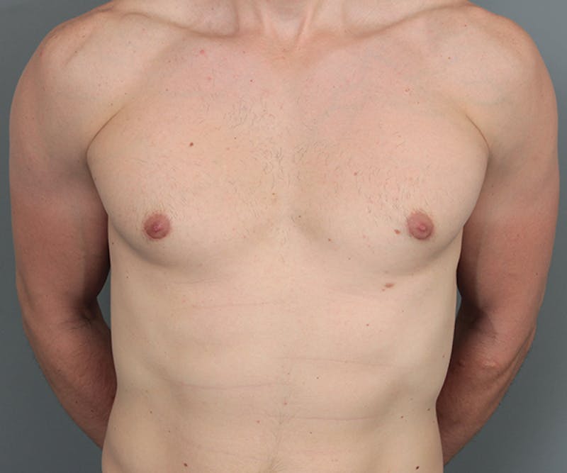 Male Breast Reduction Before & After Gallery - Patient 342061 - Image 2 - Scott Chapin, MD