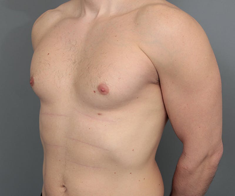 Male Breast Reduction Before & After Gallery - Patient 342061 - Image 3 - Scott Chapin, MD