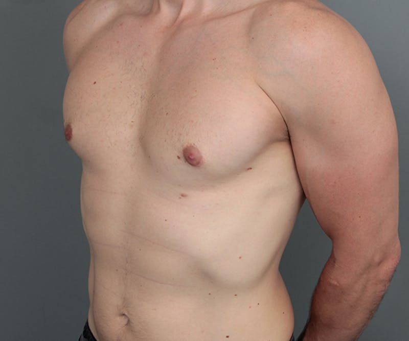 Male Breast Reduction Before & After Gallery - Patient 342061 - Image 4 - Scott Chapin, MD