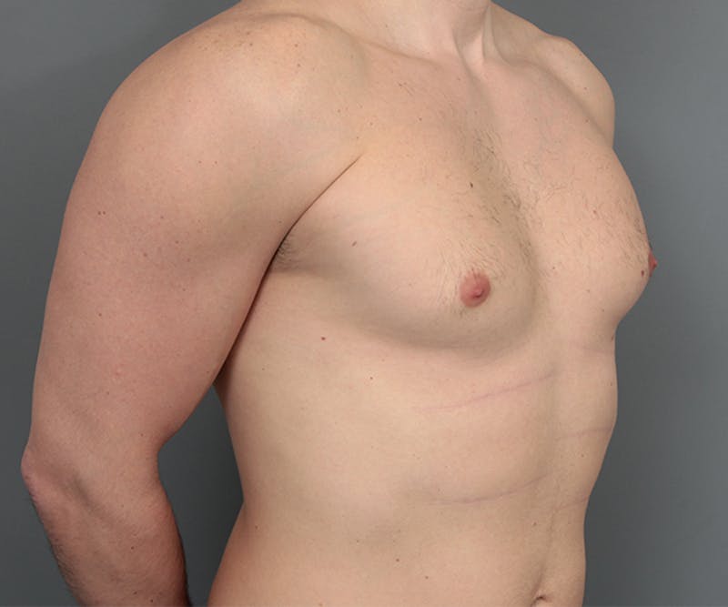 Male Breast Reduction Before & After Gallery - Patient 342061 - Image 5 - Scott Chapin, MD