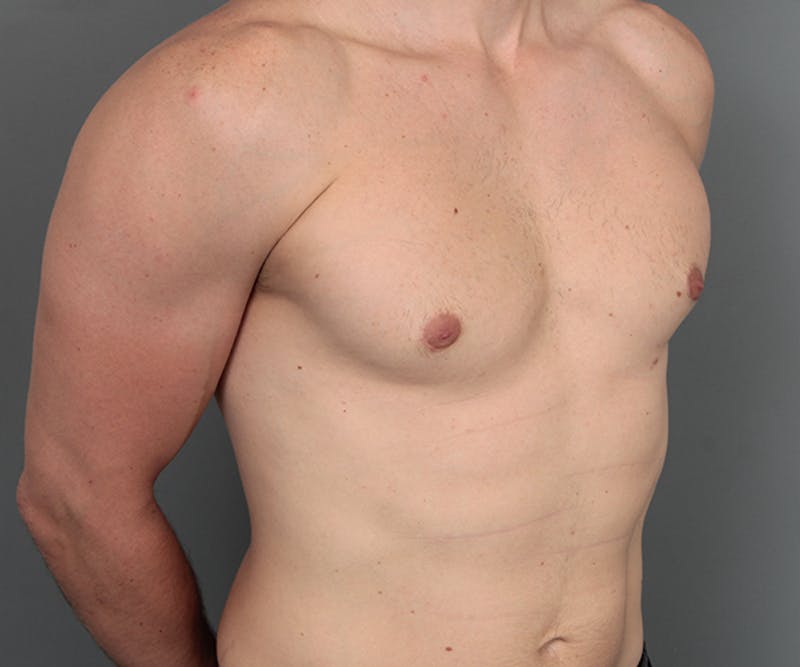 Male Breast Reduction Before & After Gallery - Patient 342061 - Image 6 - Scott Chapin, MD