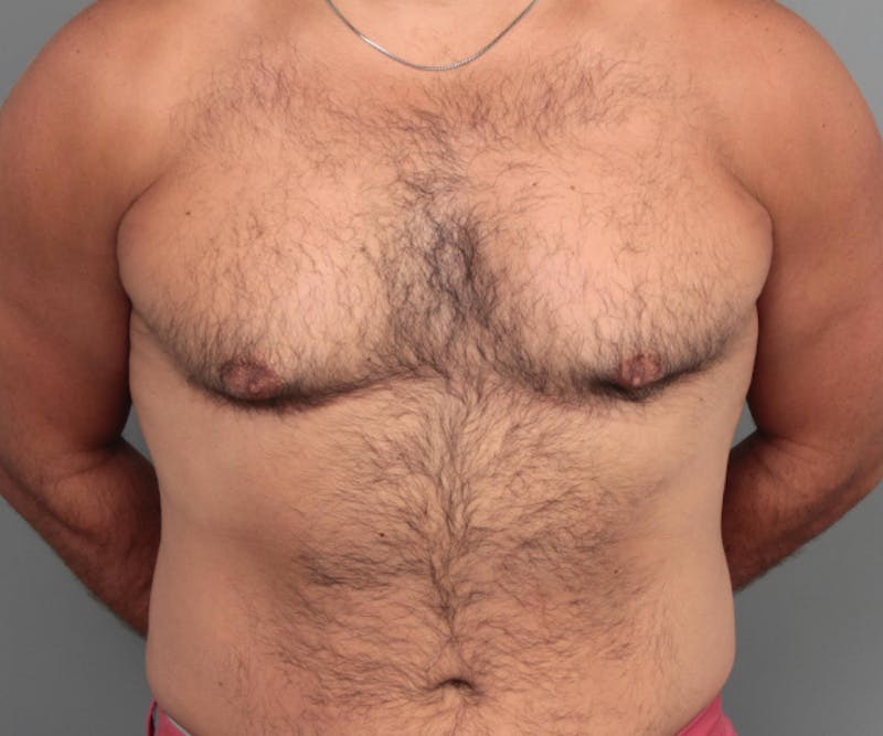 Male Breast Reduction Before & After Gallery - Patient 116994 - Image 1 - Scott Chapin, MD