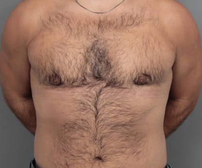 Male Breast Reduction Before & After Gallery - Patient 116994 - Image 2 - Scott Chapin, MD