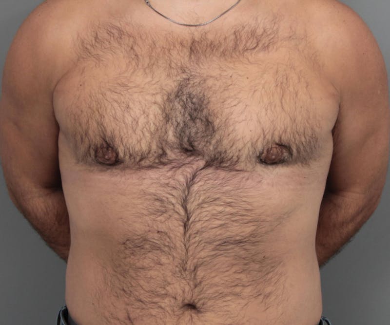Male Breast Reduction Before & After Gallery - Patient 116994 - Image 2 - Scott Chapin, MD