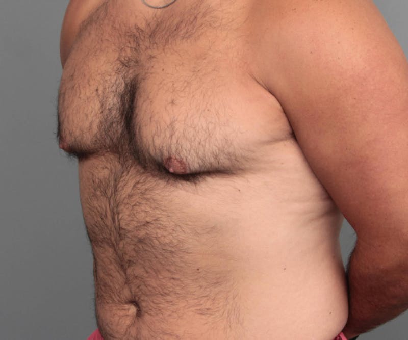 Male Breast Reduction Before & After Gallery - Patient 116994 - Image 5 - Scott Chapin, MD