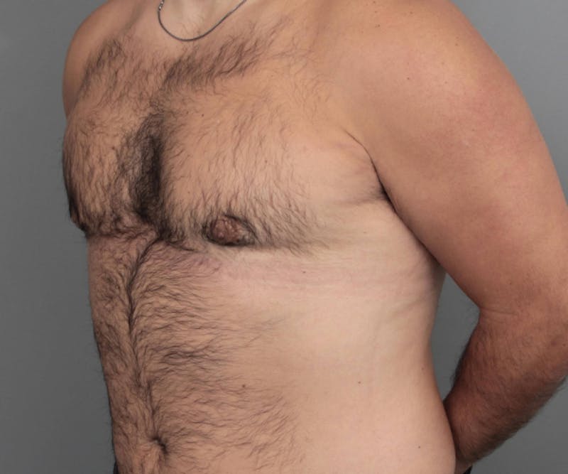 Male Breast Reduction Before & After Gallery - Patient 116994 - Image 6 - Scott Chapin, MD