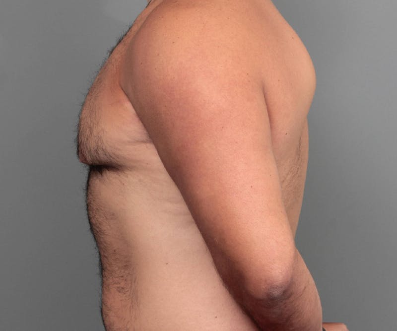 Male Breast Reduction Before & After Gallery - Patient 116994 - Image 7 - Scott Chapin, MD