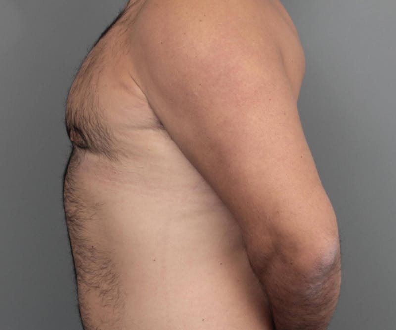 Male Breast Reduction Before & After Gallery - Patient 116994 - Image 8 - Scott Chapin, MD