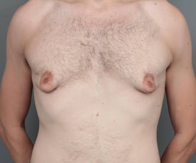 Male Breast Reduction Before & After Gallery - Patient 195141 - Image 1 - Scott Chapin, MD