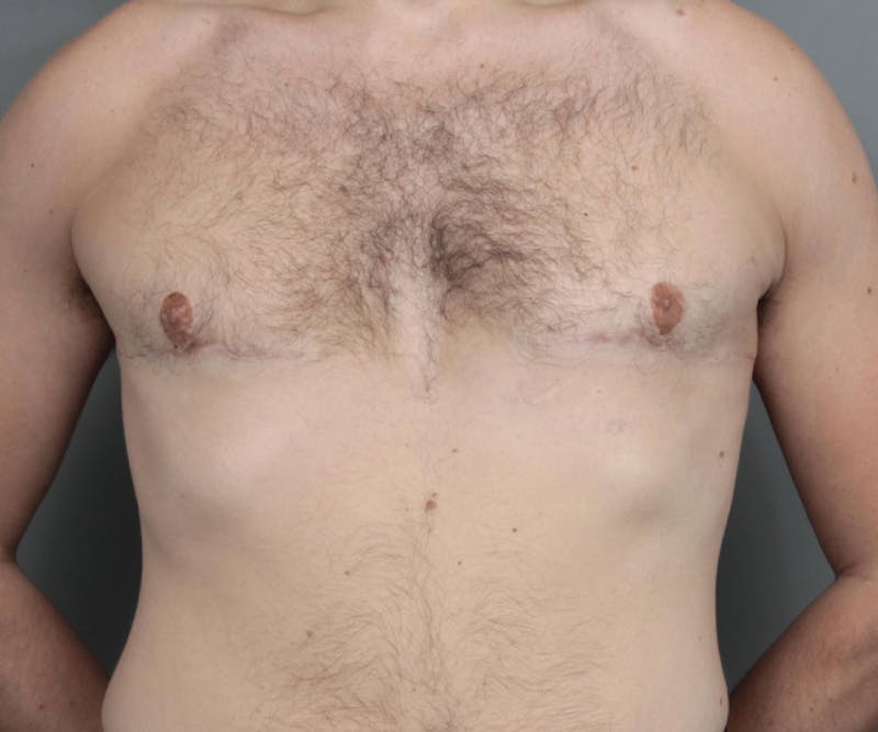 Male Breast Reduction Before & After Gallery - Patient 195141 - Image 2 - Scott Chapin, MD