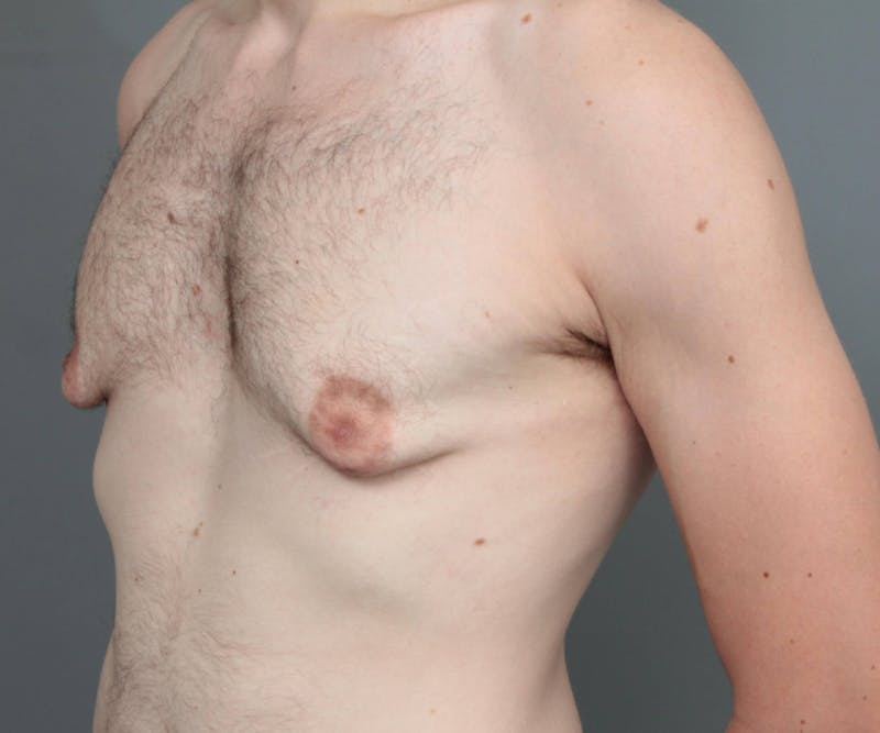 Male Breast Reduction Before & After Gallery - Patient 195141 - Image 3 - Scott Chapin, MD