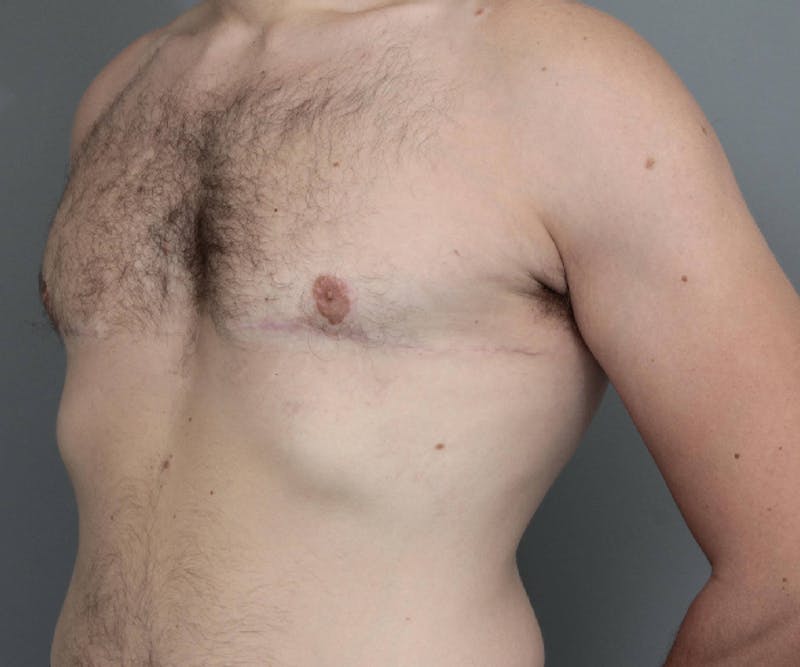 Male Breast Reduction Before & After Gallery - Patient 195141 - Image 4 - Scott Chapin, MD
