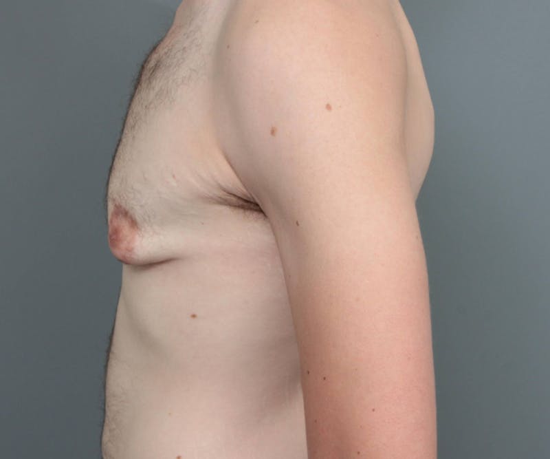 Male Breast Reduction Before & After Gallery - Patient 195141 - Image 5 - Scott Chapin, MD