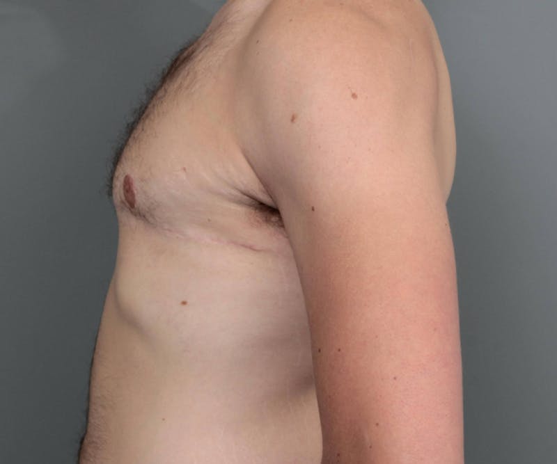 Male Breast Reduction Before & After Gallery - Patient 195141 - Image 6 - Scott Chapin, MD