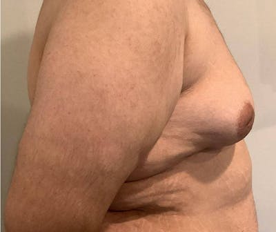 Male Breast Reduction Before & After Gallery - Patient 361124 - Image 1 - Scott Chapin, MD