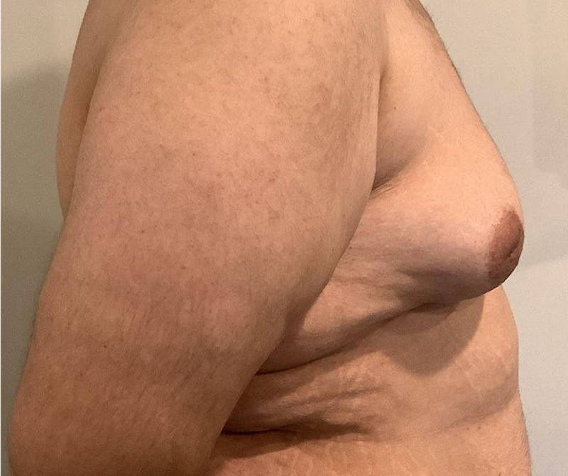 Male Breast Reduction Before & After Gallery - Patient 361124 - Image 1 - Scott Chapin, MD