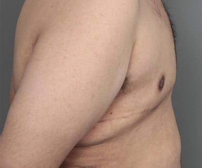Male Breast Reduction Before & After Gallery - Patient 361124 - Image 2 - Scott Chapin, MD