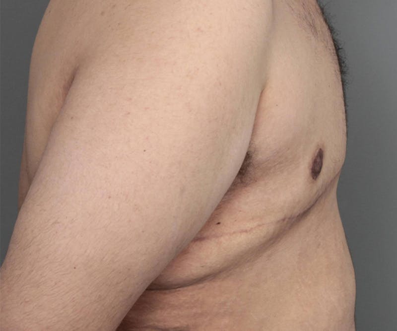 Male Breast Reduction Before & After Gallery - Patient 361124 - Image 2 - Scott Chapin, MD