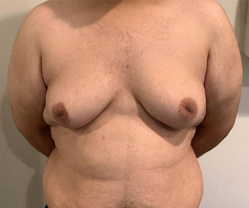 Male Breast Reduction Before & After Gallery - Patient 361124 - Image 3 - Scott Chapin, MD