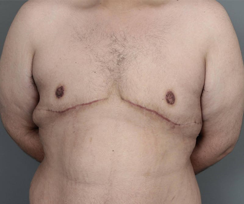 Male Breast Reduction Before & After Gallery - Patient 361124 - Image 4 - Scott Chapin, MD