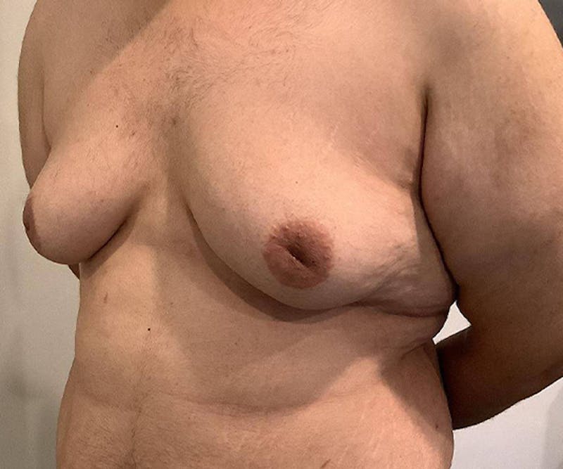 Male Breast Reduction Before & After Gallery - Patient 361124 - Image 7 - Scott Chapin, MD
