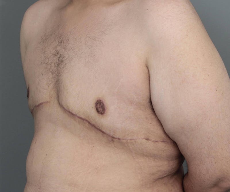 Male Breast Reduction Before & After Gallery - Patient 361124 - Image 8 - Scott Chapin, MD