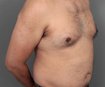 Male Breast Reduction Before & After Gallery - Patient 207146 - Image 1 - Scott Chapin, MD