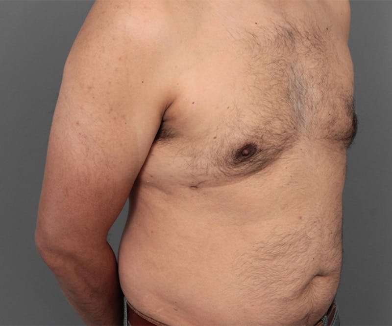 Male Breast Reduction Before & After Gallery - Patient 207146 - Image 2 - Scott Chapin, MD
