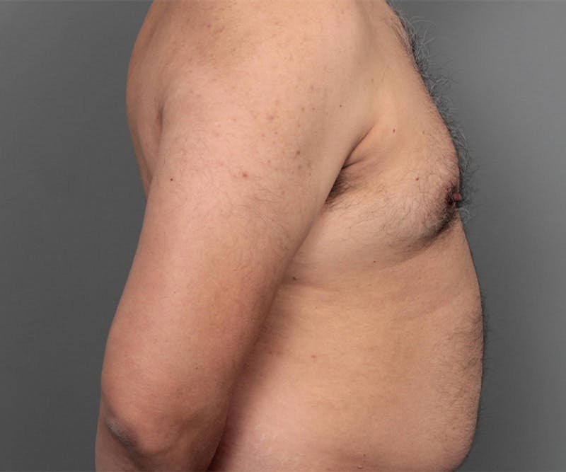 Male Breast Reduction Before & After Gallery - Patient 207146 - Image 5 - Scott Chapin, MD