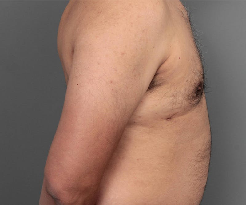 Male Breast Reduction Before & After Gallery - Patient 207146 - Image 6 - Scott Chapin, MD