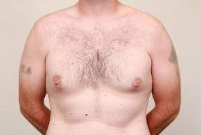 Male Breast Reduction Before & After Gallery - Patient 216761 - Image 1 - Scott Chapin, MD