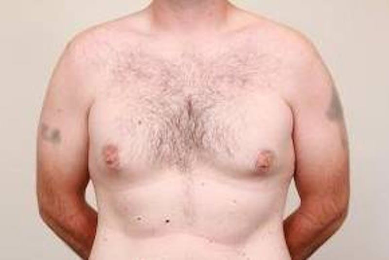 Male Breast Reduction Before & After Gallery - Patient 216761 - Image 1 - Scott Chapin, MD