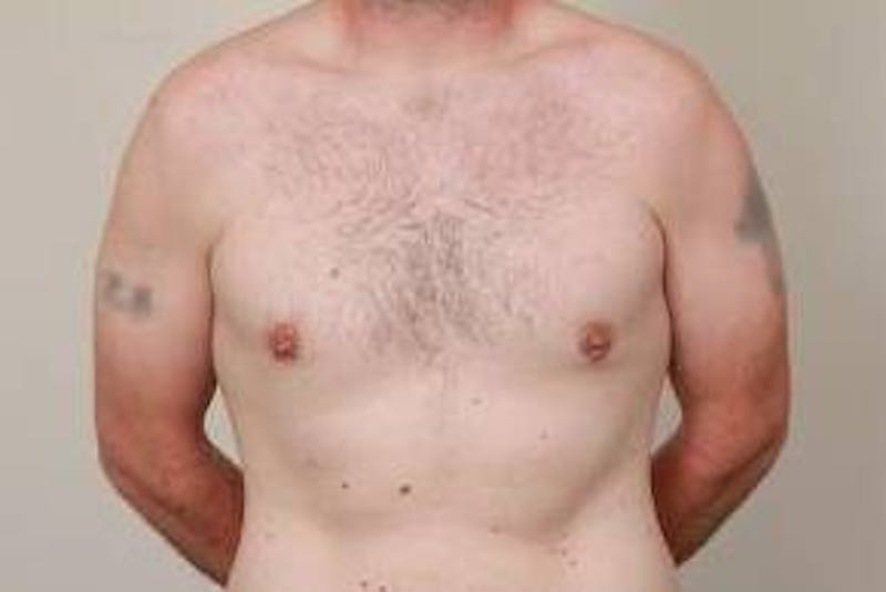 Male Breast Reduction Before & After Gallery - Patient 216761 - Image 2 - Scott Chapin, MD
