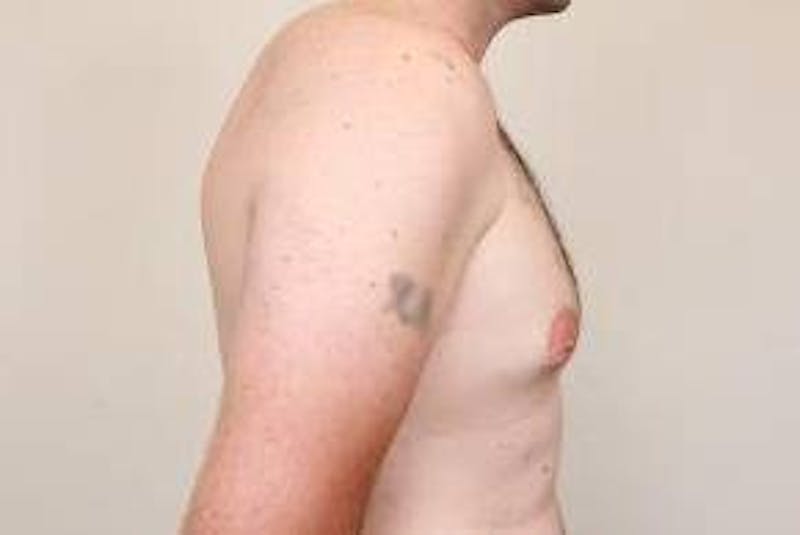 Male Breast Reduction Before & After Gallery - Patient 216761 - Image 5 - Scott Chapin, MD