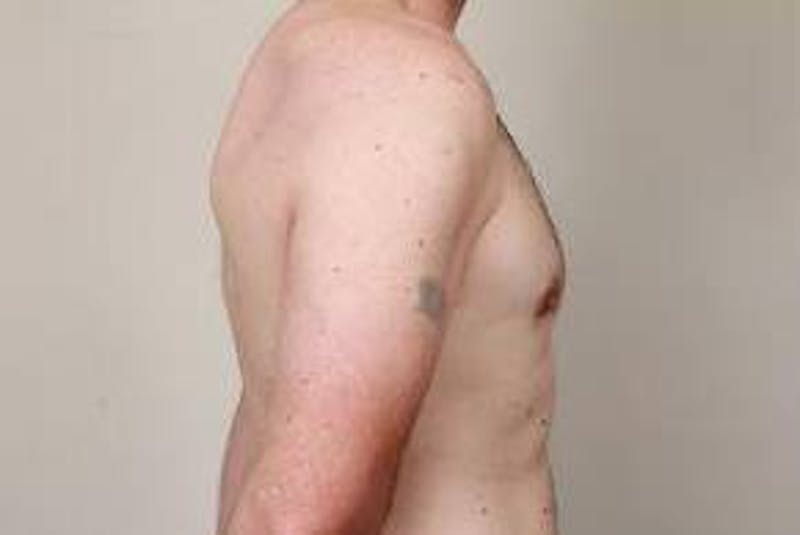 Male Breast Reduction Before & After Gallery - Patient 216761 - Image 6 - Scott Chapin, MD