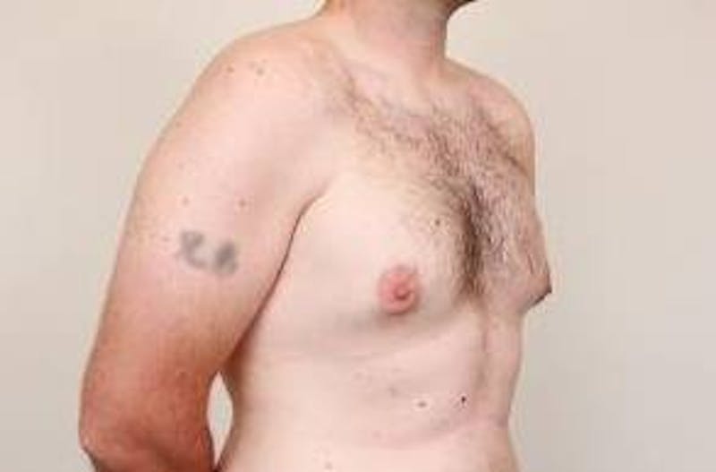Male Breast Reduction Before & After Gallery - Patient 216761 - Image 7 - Scott Chapin, MD